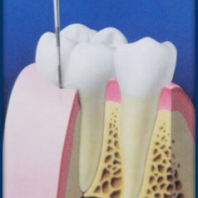 Periodontics and Gum Disease Treatment