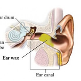 Cerumen (ear wax) Removal in Naperville IL