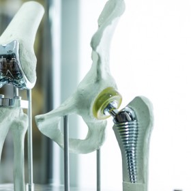 Why Choose Robotic Knee Surgery At Arthrobotix?