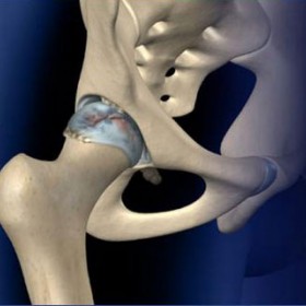Fluoroscopic Guided Hip Injection