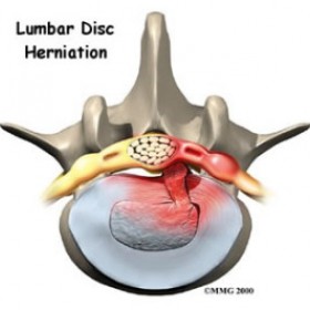 Disc Herniation Treatment New Jersey